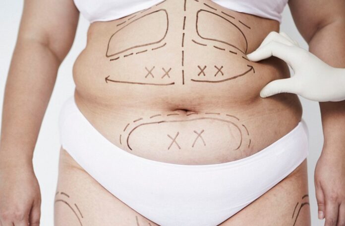 Liposculpture