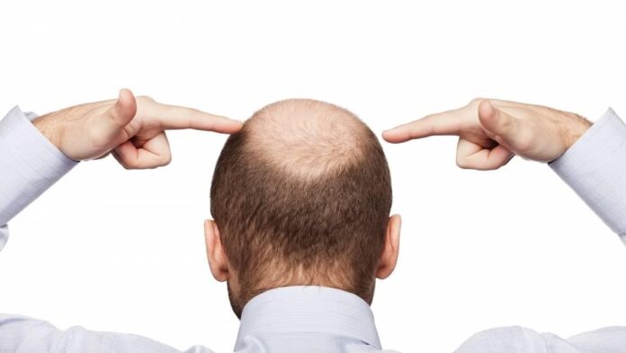 Hair Transplant