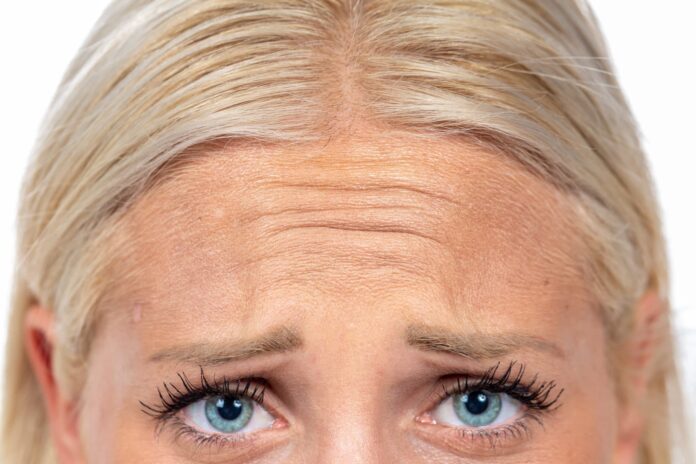 Forehead-Lines-