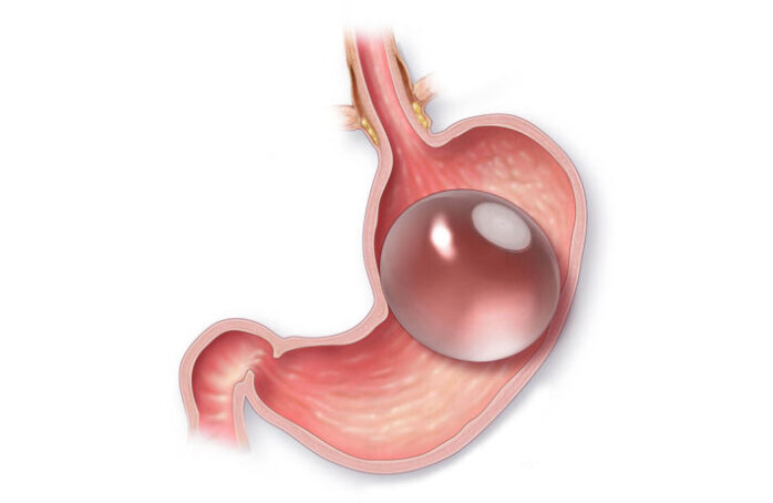 Gastric Sleeve Turkey