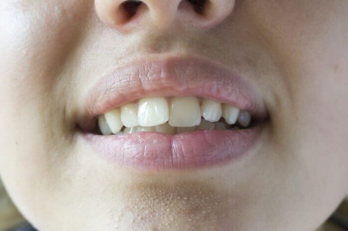 Crooked Teeth