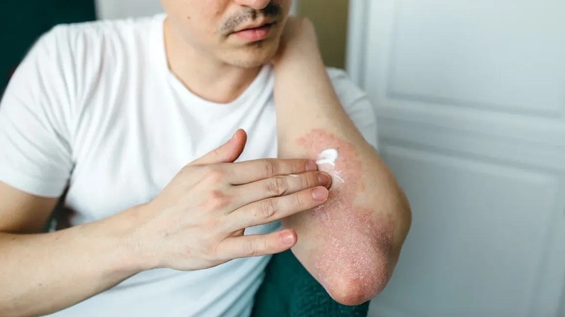 Psoriasis